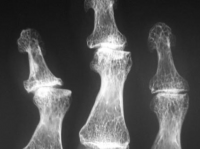 /album/a3/osteoartrose-v-png/